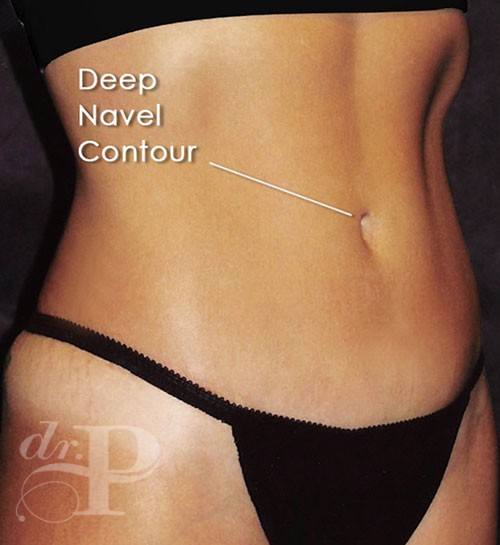 Recuperación de la Forma del Ombligo