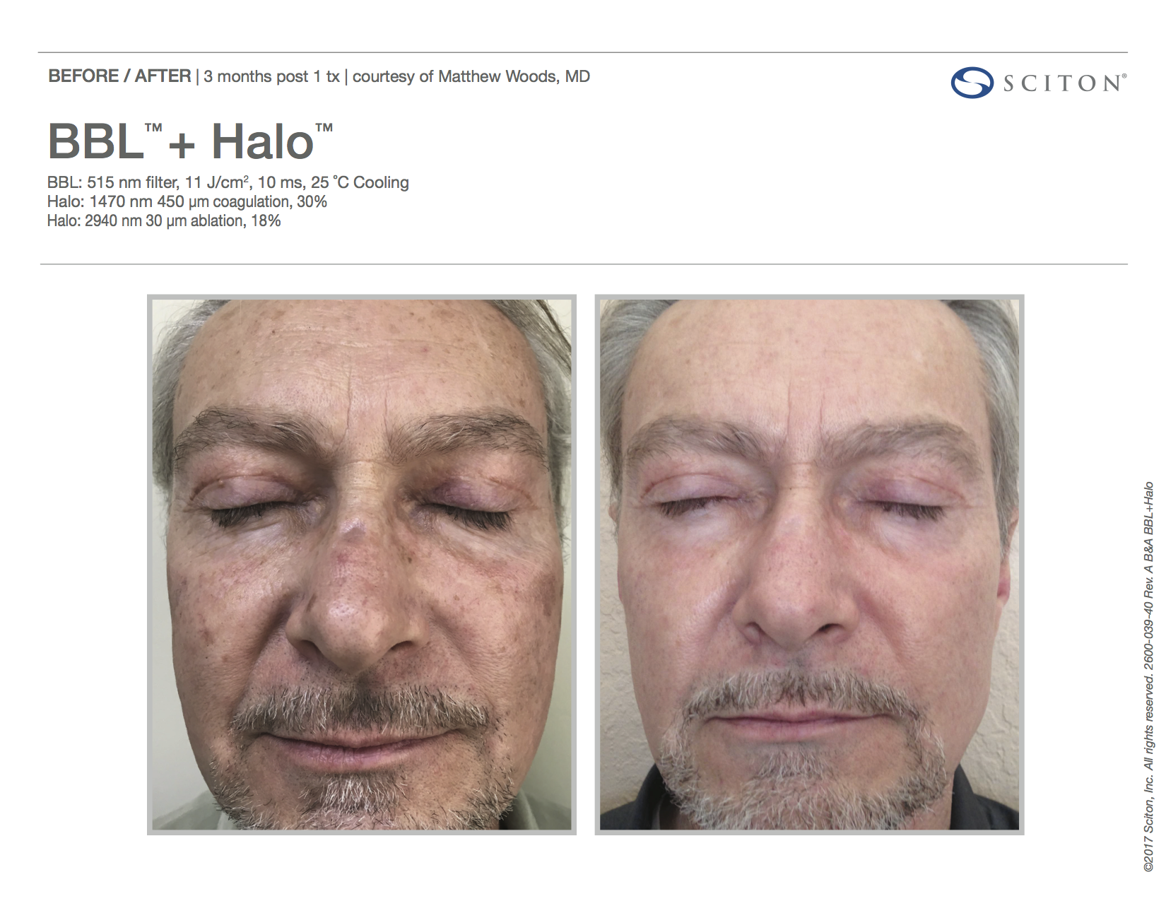 BBL™ + Halo™ Patient Before & After