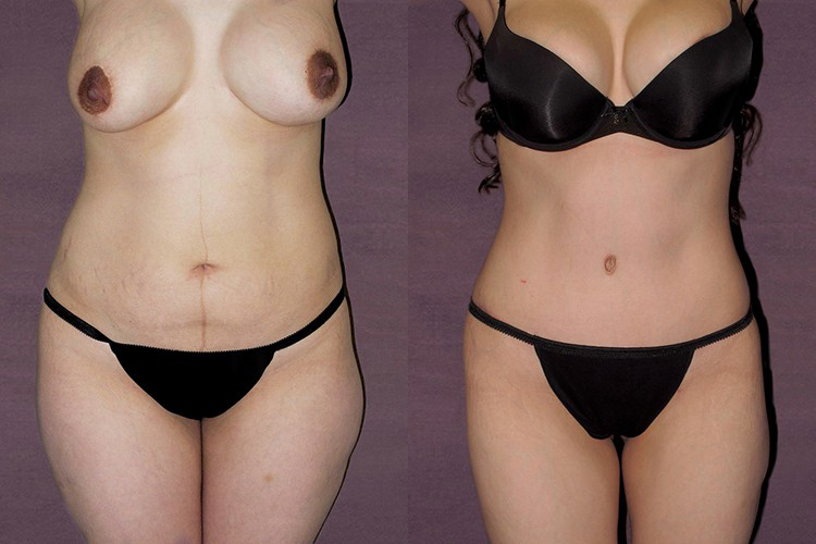 Before and after of body lift