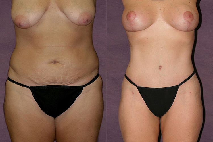 Before and after of thigh lift