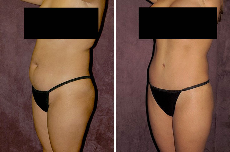 Before and after: muscle tightening