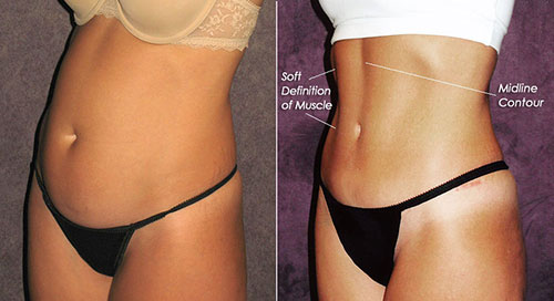 Before and after of abdominal contouring