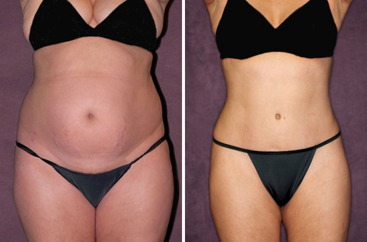 Before and after of waist contouring