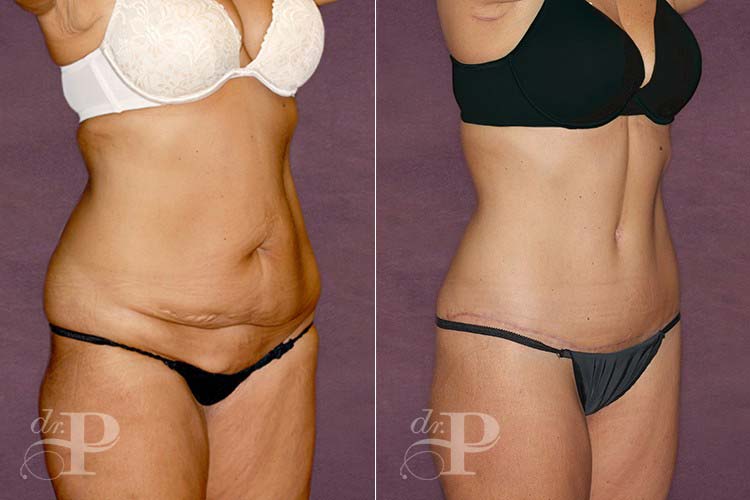 Before and after of a body lift procedure