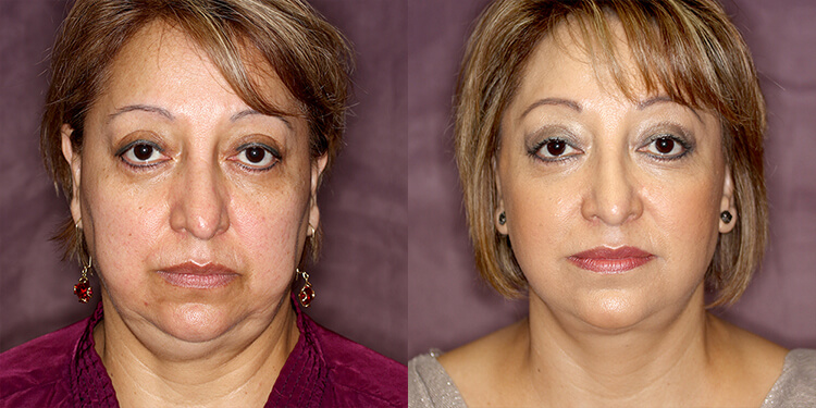 Facelift & Neck Lift Surgery Before and After Photos
