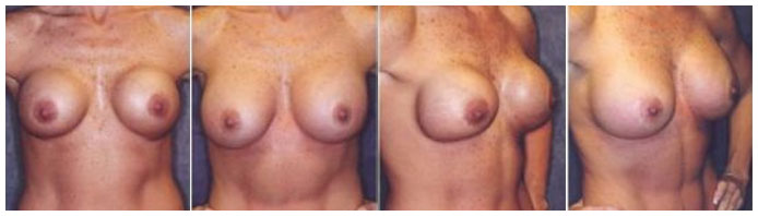 Before and After, Breast Revision