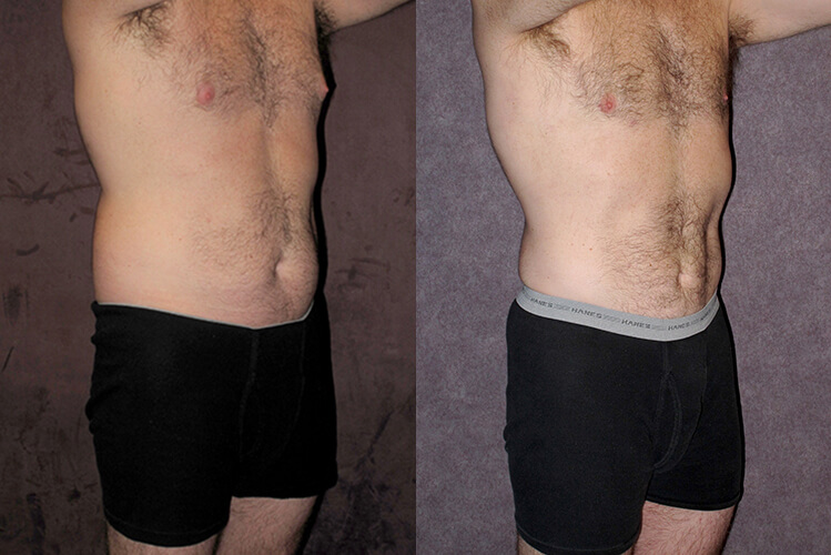 Body Contouring for Men Before and After Patient Photos