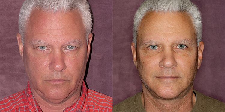 Rejuvenation of Male Face & Neck Before and After Photos