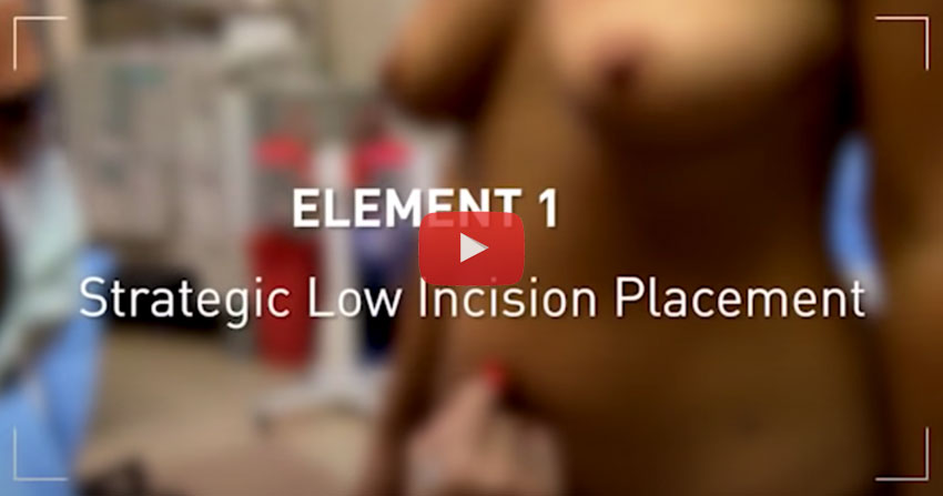 Técnica True Form Tummy Tuck: En Cirugía