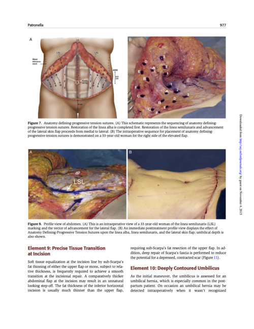 "Redefining Abdominal Anatomy: 10 Key Elements for Restoring Form in Abdominoplasty" | Aesthetic Surgery Journal