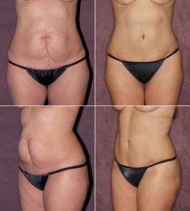Prior to having a True Form Tuck with Dr. Patronella, this mother of 2 was self-conscious about the appearance of her abdomen, which she described as looking like “front buttocks.” This was caused by the C-section adhering to the tissues beneath it, making the loose skin surrounding appear more prominent. Dr. Patronella removed her C-Section scar and loose skin, resculpting her abdomen to give it a sexy, smooth, softly contoured appearance.