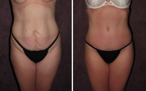 True Form Tummy Tuck Patient of Dr. Patronella
