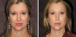 Restylane, Perlane to diminish facial lines