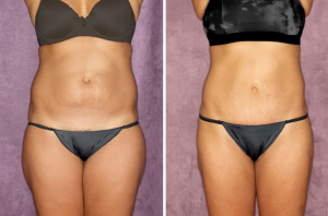 Patronella Liposuction patient