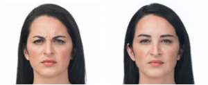 Botox Cosmetic Before and After