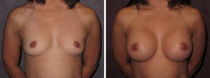 Breast Aug by Dr. Patronella