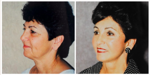 Facelift Patient who also had newlift, browlift and eyelid surgery by Dr. Patronella