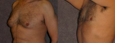 GYNECOMASTIA Patient by Dr. Patronella