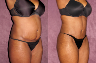 Patronella True From Tummy Tuck before and after case