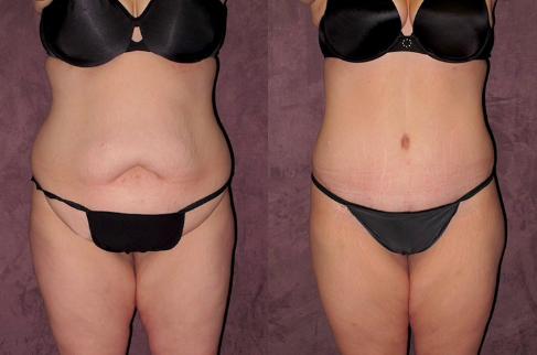 Post-Weight Loss Before & After