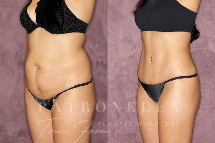 True Form Tummy Tuck Before and After Results Side View by Dr. Patronella