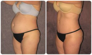 True Form Tummy Tuck Patient by Dr. Patronella