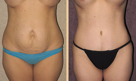 Tummy Tuck Before & After