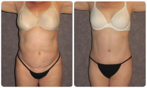 Tummy Tuck Before & After