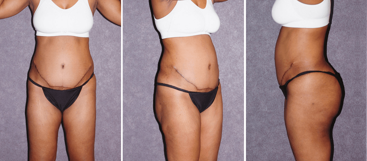 Tummy Tuck Pitfalls Patient 4