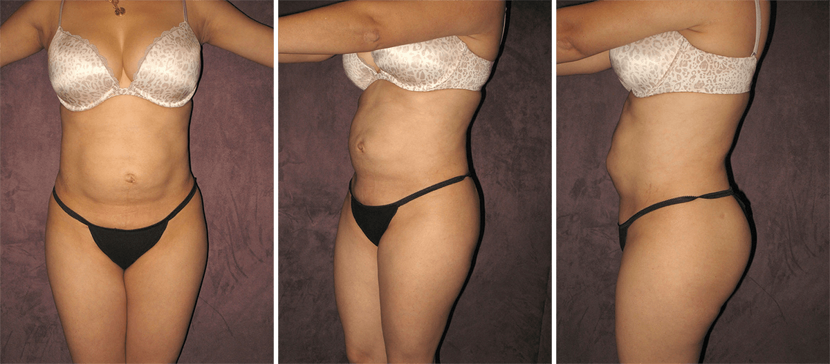 Tummy Tuck Pitfalls Patient 5