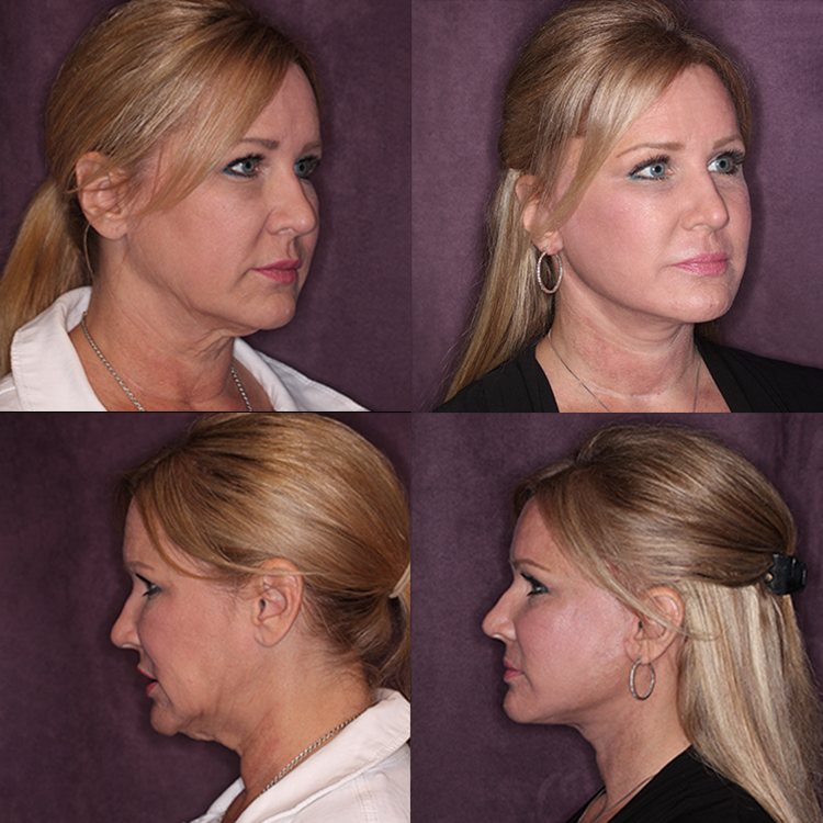Tracy, before and after her facelift, necklift, and skin laser procedures