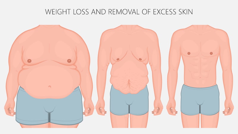 A graphic showing why removing excess skin helps after significant weight loss.
