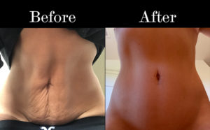 Reverse Tummy Tuck Patient