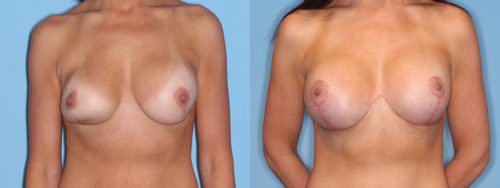 Reverse Tummy Tuck Patient