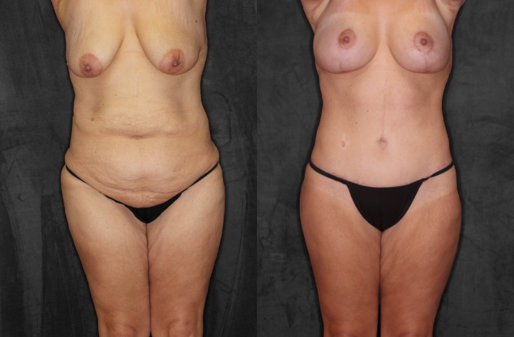 True Form Tummy Tuck Patient